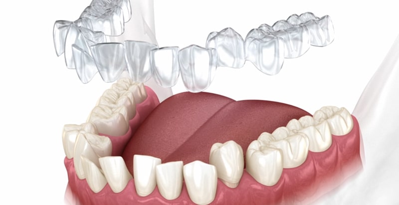 Clear Aligners / Orthodontics