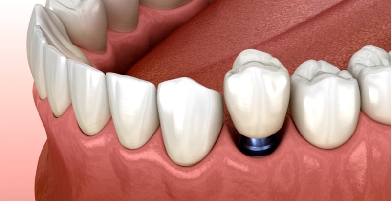 Dental Implants