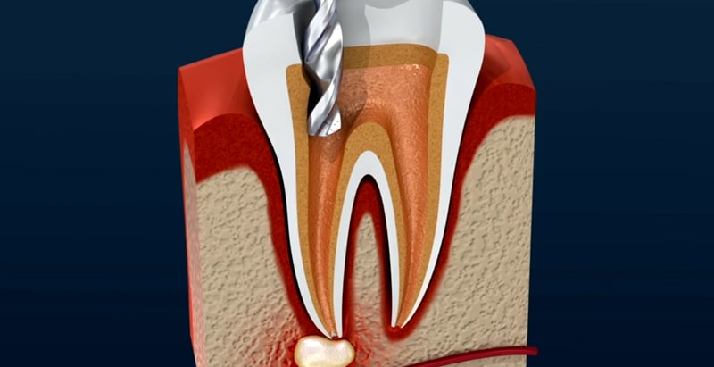 Root Canal