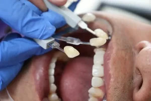 High-Quality Dental Crowns Etobicoke