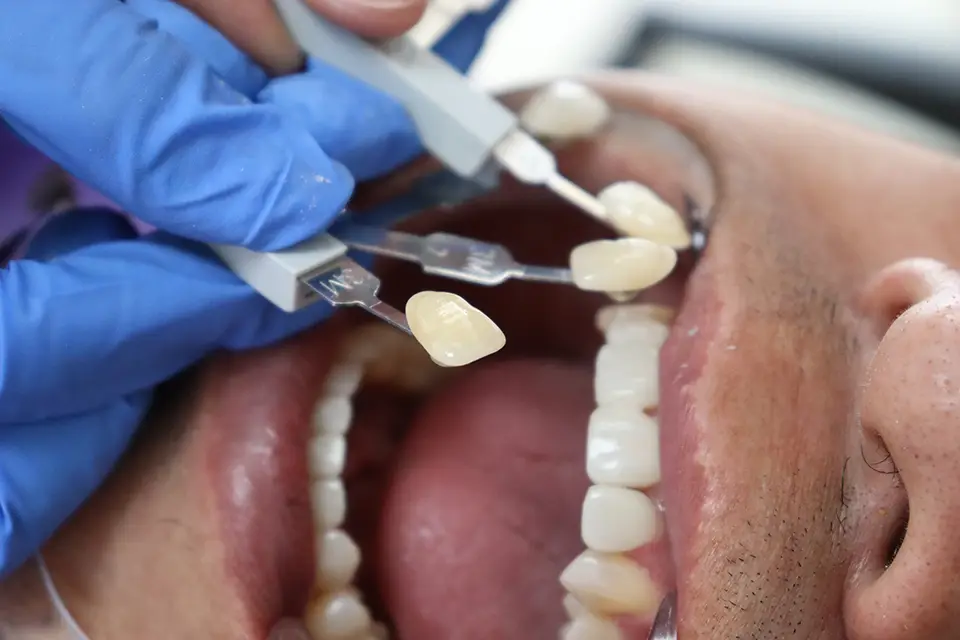 High-Quality Dental Crowns Etobicoke