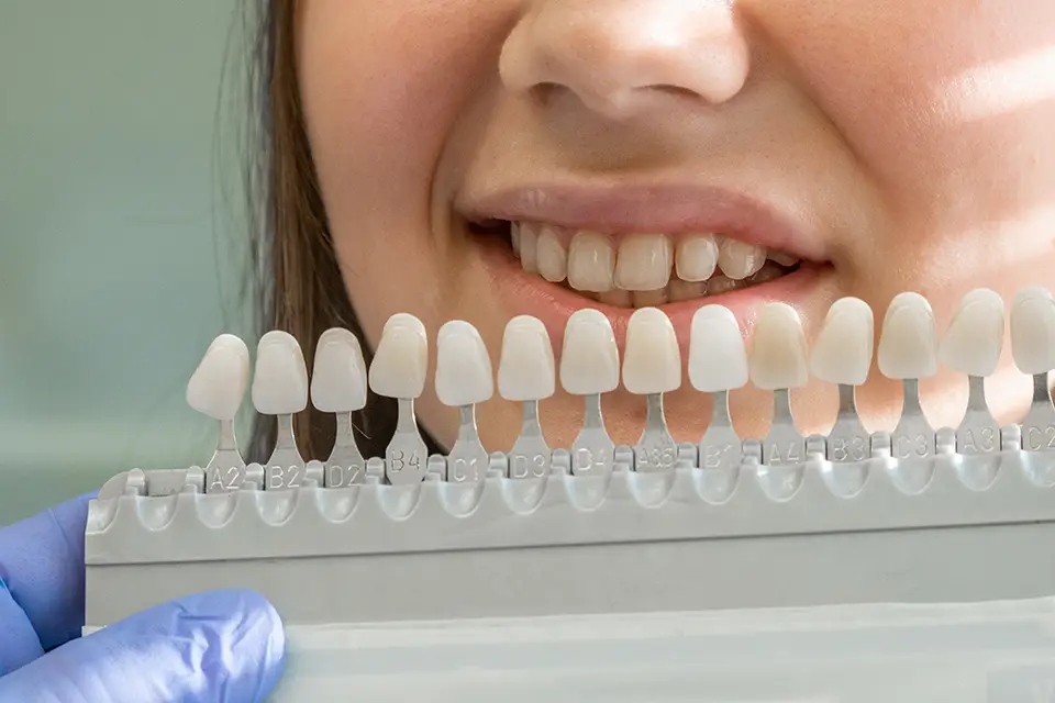 Transform Your Smile with Dental Veneers Etobicoke