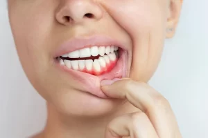 Bleeding Gums Etobicoke Dentist Explains Causes and Treatment