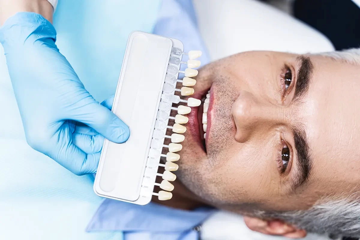 Dental Veneers