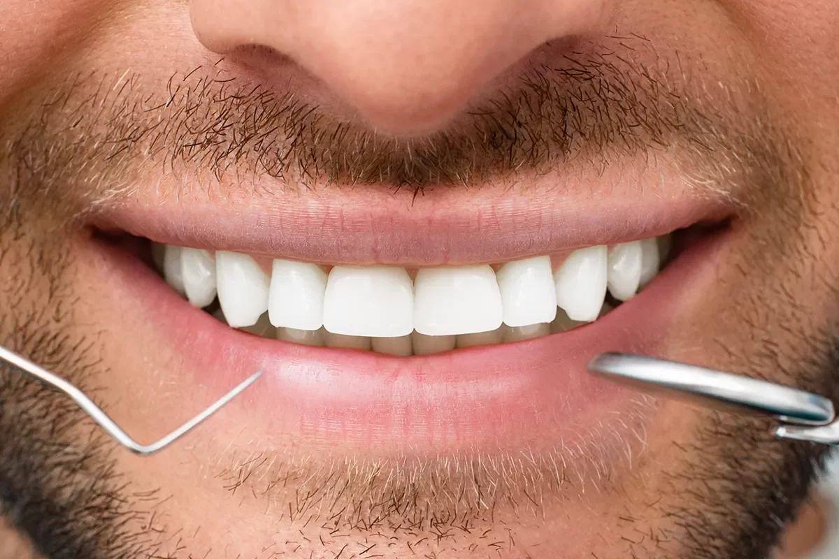 Dental Bonding