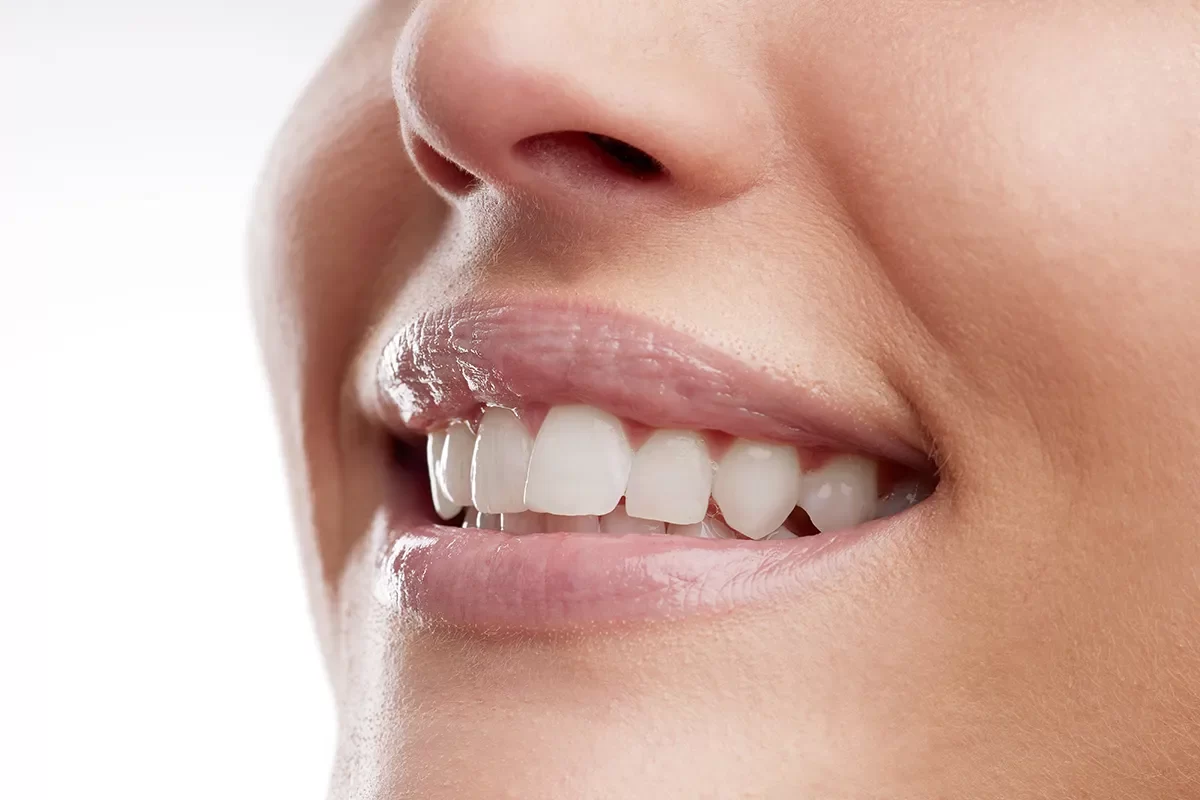 Dental Sealants - 02