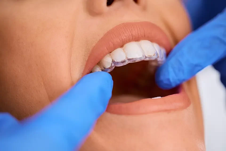 How Long Does Invisalign Take to Work: Treatment Timeline and Key Factors